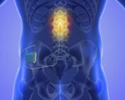 Spinal Cord Stimulator Example