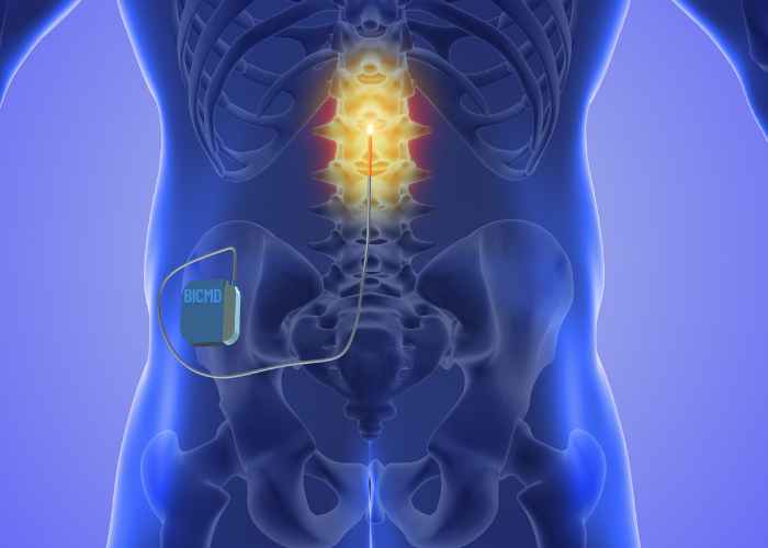 Spinal Cord Stimulator Example